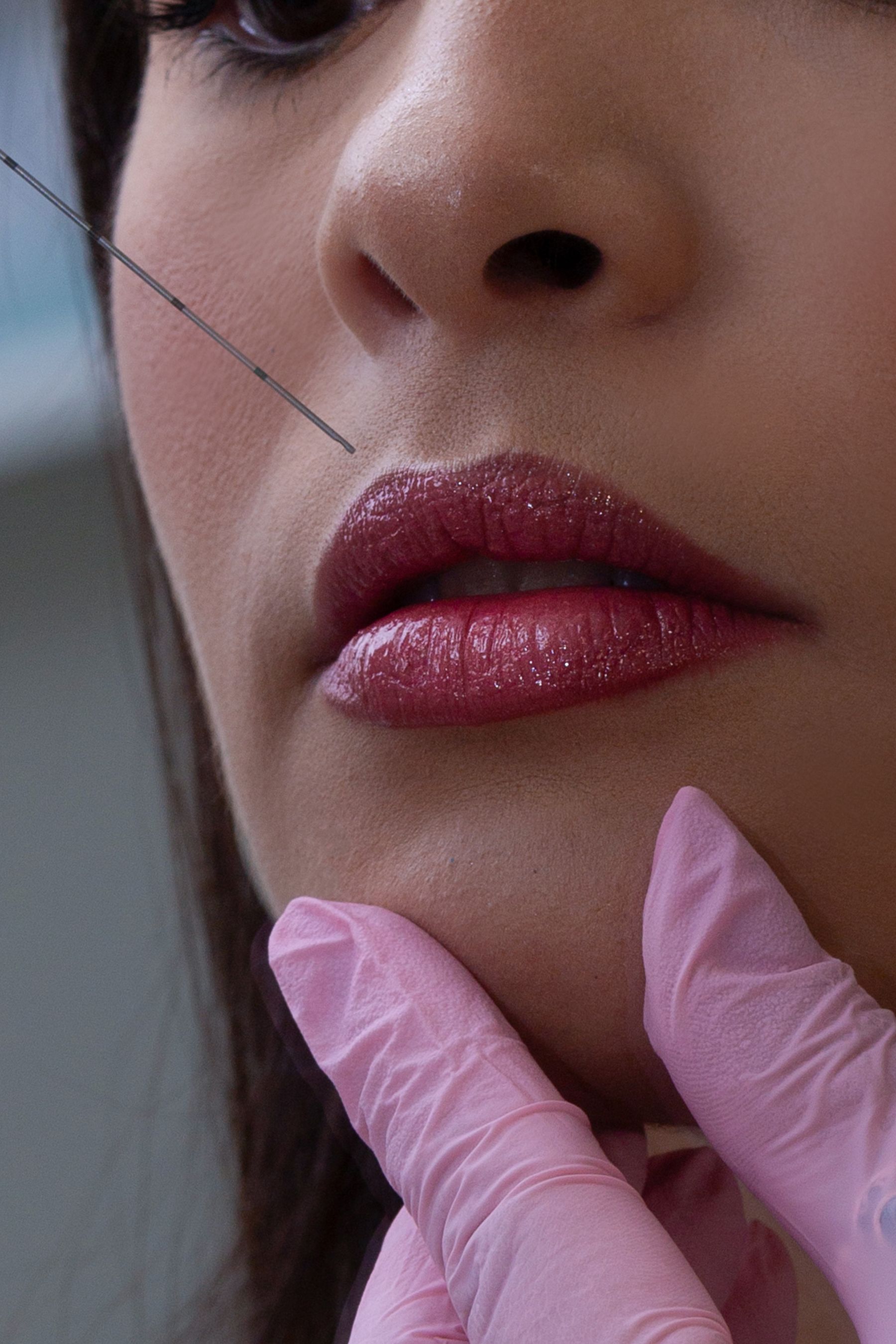 Preenchimento facial na Lumière Estética